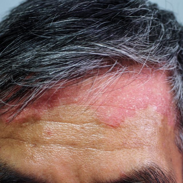 Lupénka je chronické zánětlivé kožní onemocnění,  které není infekční | foto: Shutterstock