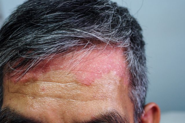 Lupénka je chronické zánětlivé kožní onemocnění,  které není infekční | foto: Shutterstock