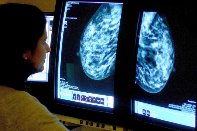 Výsledky z mamografie. Ilustrační foto | foto: Profimedia