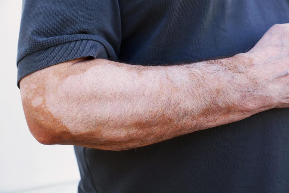 Onemocnění vitiligo se projevuje bílými hladkými skvrnami,  které jsou ostře ohraničené  (ilustrační foto) | foto: Profimedia